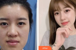 重慶時光整形美容醫(yī)院姜民范整形價格表附假體隆鼻案例展示