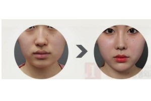 什么是頦部填充術(shù)，如何快速消腫