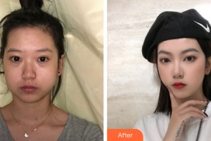 深圳金美人整形外科門診部段國新整形價格表附下頜角手術(shù)案例展示