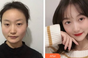 滄州瑞美醫(yī)療美容門診部張鵬整形價格表附下頜角手術(shù)案例展示