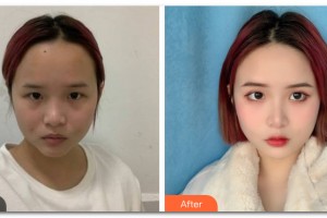 云南華美美萊美容醫(yī)院宋萍整形價(jià)格表附激光美膚案例展示