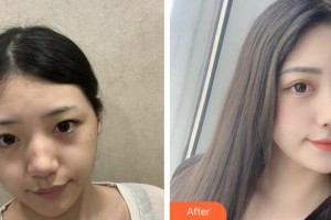 成都漢密爾頓美容醫(yī)院尚瑜整形價(jià)格表附激光祛斑案例展示