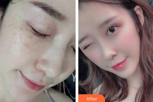 上海美立方整形醫(yī)院王守軍整形價(jià)格表附超激光美膚+祛斑針展示