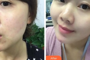 上海港華醫(yī)院浦東分院（悅?cè)葆t(yī)療美容診所）穆雄錚整形價(jià)格表附果酸煥膚案例展示