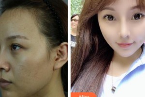 上海天大醫(yī)療美容醫(yī)院劉斌整形價(jià)格表附顴骨+頰脂墊+中面部提升術(shù)案例展示