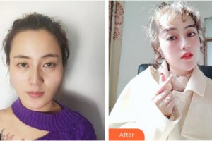 成都春天醫(yī)療美容門診部廖建春整形價(jià)格表附面部輪廓案例展示