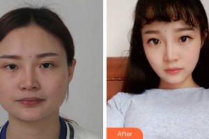 上海解放軍第四五五醫(yī)院激光整形科宣慶元 整形價(jià)格表附DA·頜面整形案例展示