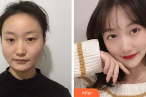 上海解放軍第四五五醫(yī)院激光整形科孫廣慈整形價(jià)格表附激光溶脂瘦臉案例展示