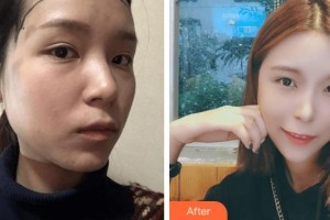 上海華美醫(yī)療美容醫(yī)院袁玉坤整形價(jià)格表附女性發(fā)際線種植案例展示