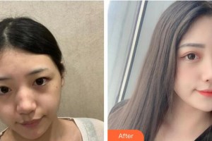 廣州現(xiàn)代醫(yī)院數(shù)字化整形美容中心廖曉蕓整形價格表附激光祛斑案例展示