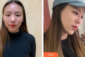 廣州現(xiàn)代醫(yī)院數(shù)字化整形美容中心劉志剛整形價格表附自體肋軟骨隆鼻案例展示