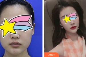 廣州軍頤醫(yī)院整形美容中心官小書整形價格表附面部脂肪填充案例展示