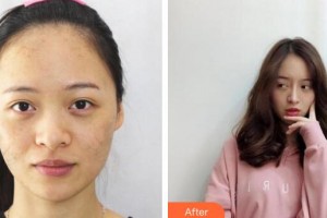 廣州軍區(qū)總醫(yī)院全軍激光整形美容中心廖元興整形價格表附激光美膚激光祛斑案例展示