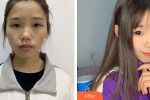 廣州軍區(qū)總醫(yī)院全軍激光整形美容中心程飚整形價格表附超激光美膚案例展示