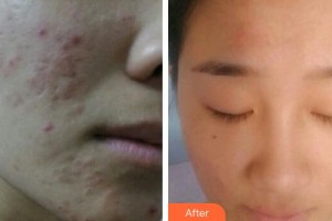 廣州軍區(qū)總醫(yī)院全軍激光整形美容中心苑凱華整形價格表附激光祛痘坑痘印案例展示