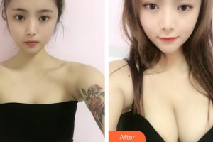 廣州遠(yuǎn)東美容醫(yī)院王魁然 教授整形價格表附內(nèi)窺鏡雙平面假體隆胸案例展示