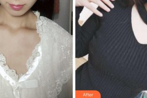 廣州星團醫(yī)學(xué)美容門診部楊昆兵整形價格表附假體隆胸案例展示