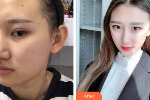 廣州星團(tuán)醫(yī)學(xué)美容門診部廖國(guó)善整形價(jià)格表附面部吸脂瘦臉案例展示