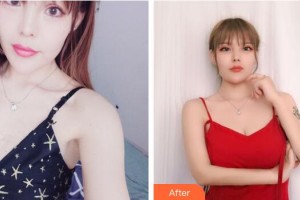 廣州醫(yī)學(xué)院第二附屬醫(yī)院整形美容中心聶冬生整形價(jià)格表附假體隆胸案例展示