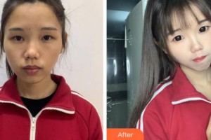 上海仁愛(ài)醫(yī)院整形美容科趙軍整形價(jià)格表附面部吸脂案例展示