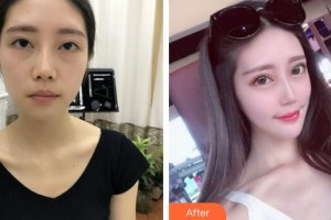 廣州曙光醫(yī)學(xué)美容醫(yī)院蔡方明院長(zhǎng)整形價(jià)格表附假體下巴案例展示