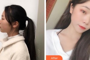 上海仁愛(ài)醫(yī)院整形美容科申翰耕韓國(guó)“除皺回春”魔術(shù)師整形價(jià)格表附光子嫩膚案例展示