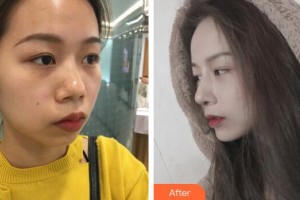 廣州美萊醫(yī)療美容醫(yī)院李逢整形價(jià)格表附假體墊下巴案例展示