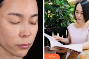 上海仁愛(ài)醫(yī)院整形美容科陳峰整形價(jià)格表附面部補(bǔ)水祛皺案例展示