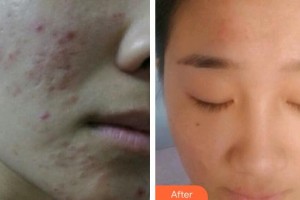 上海仁愛(ài)醫(yī)院整形美容科馬艷整形價(jià)格表附激光祛痘坑痘印案例展示