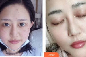 上海時(shí)光整形外科醫(yī)院左雯君整形價(jià)格表附色斑痘印暗黃出油皺紋案例展示