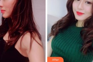 上海時(shí)光整形外科醫(yī)院李靈巧整形價(jià)格表附假體隆胸案例展示