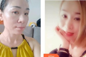 上海時(shí)光整形外科醫(yī)院張克敏整形價(jià)格表附激光祛斑案例展示