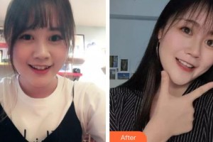 上海時(shí)光整形外科醫(yī)院王志遠(yuǎn)整形價(jià)格表附金屬托槽矯正案例展示