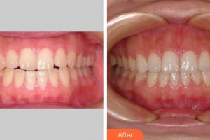 廣州時(shí)光整形美容醫(yī)院侯振杰整形價(jià)格表附牙齒正畸案例展示