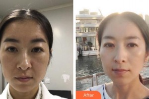 廣州曙光醫(yī)學(xué)美容醫(yī)院?jiǎn)瘟颊蝺r(jià)格表附熱瑪吉案例展示