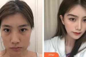 上海萬(wàn)眾醫(yī)院醫(yī)療美容科文錦花整形價(jià)格表附下頜角切除案例展示