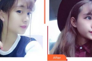 上海萬(wàn)眾醫(yī)院醫(yī)療美容科金炳國(guó)整形價(jià)格表附牛奶酸煥膚案例展示