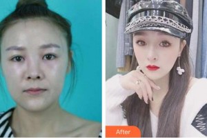 上海美立方整形醫(yī)院王志剛整形價格表附面包臉到鴨蛋臉變形記案例展示