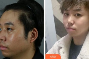 上海首爾麗格醫(yī)療美容醫(yī)院洪性范整形價格表附下頜角+皮質(zhì)骨+夾脂墊案例展示