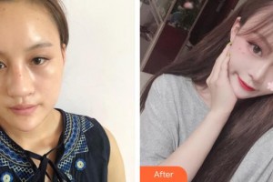 沈陽金皇后整形美容醫(yī)院朱久平整形價格表附眼部整形眼部綜合案例展示