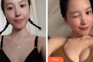 廣州曙光醫(yī)學(xué)美容醫(yī)院張?jiān)堈蝺r(jià)格表附濃縮豐胸案例展示