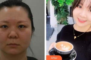 廣州博仕整形美容醫(yī)院朱平整形價(jià)格表附多方面部埋線提升案例展示