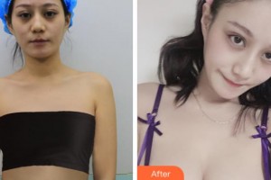 沈陽杏林整形美容醫(yī)院史靈芝整形價格表附假體隆胸，棉花糖假體隆胸案例展示