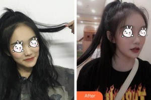 上海天大醫(yī)療美容醫(yī)院盧京鉉整形價格表附無針水光案例展示