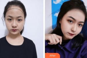 上海天大醫(yī)療美容醫(yī)院金修均整形價格表附美女發(fā)際線種植案例展示