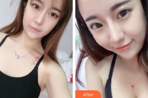 上海天大醫(yī)療美容醫(yī)院朱健康整形價格表附濃縮脂肪豐胸案例展示