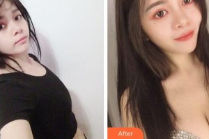 廣州中科美整形醫(yī)院孫中生整形價格表附假體隆胸案例展示