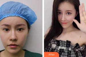 上海一美整形外科醫(yī)院　岳偉整形價格表附	膨體豐眉弓案例展示