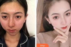 廣州新時代整形美容醫(yī)院饒曉艷美容皮膚醫(yī)師 咨詢培訓(xùn)師整形價格表附健康素顏肌案例展示