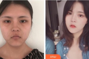 上海康奧醫(yī)療美容醫(yī)院李倩玉整形價格表附埋線提升案例展示